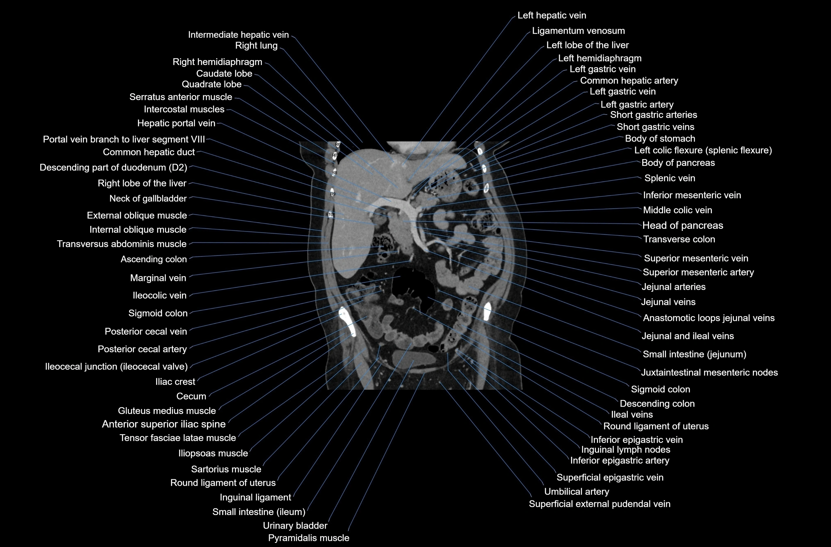 CT abdomen coronal cross sectional anatomy labelled radiology image-00035.webp